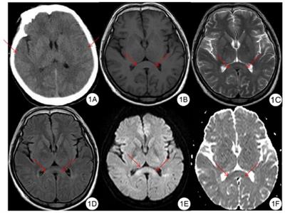 Study of high-altitude cerebral edema using multimodal imaging